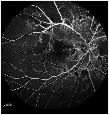 Retinal vein changes after treatment with aflibercept and PRP in high-risk proliferative diabetic retinopathy